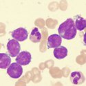 Leukaemia cells