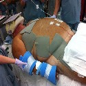 Obese trauma