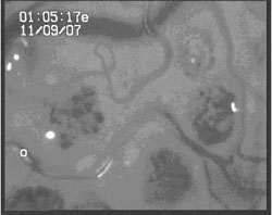 Platelets (white) accumulating in inflamed glomeruli