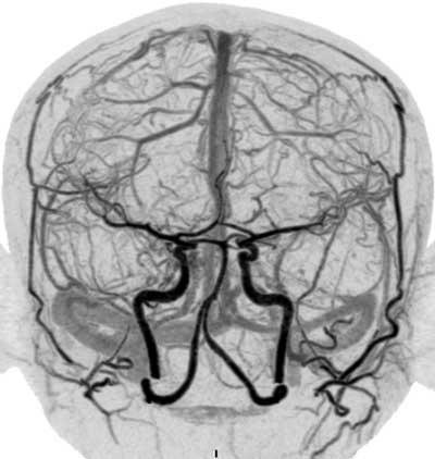 Cerebral Circulation
