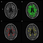 Morphological segmantation of age-related white matter lesions